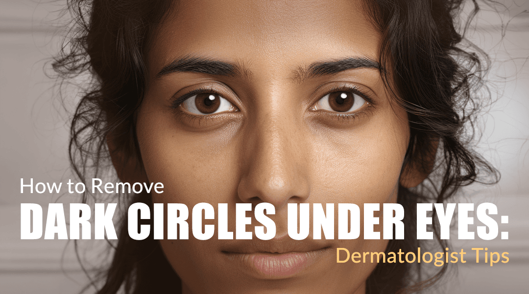 How to Remove Dark Circles Under Eyes: Dermatologist Tips